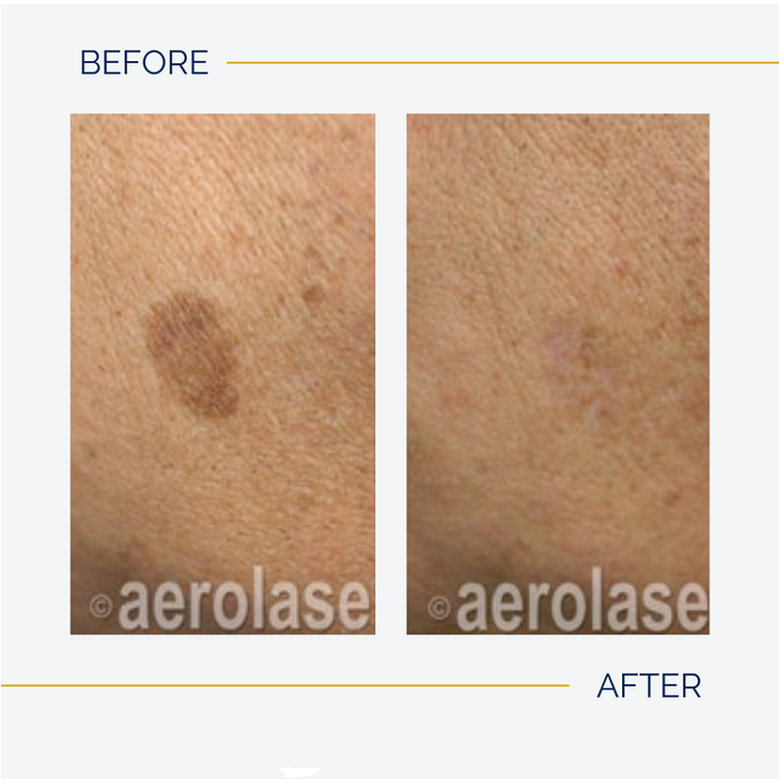 removing dark spots in Hendersonville